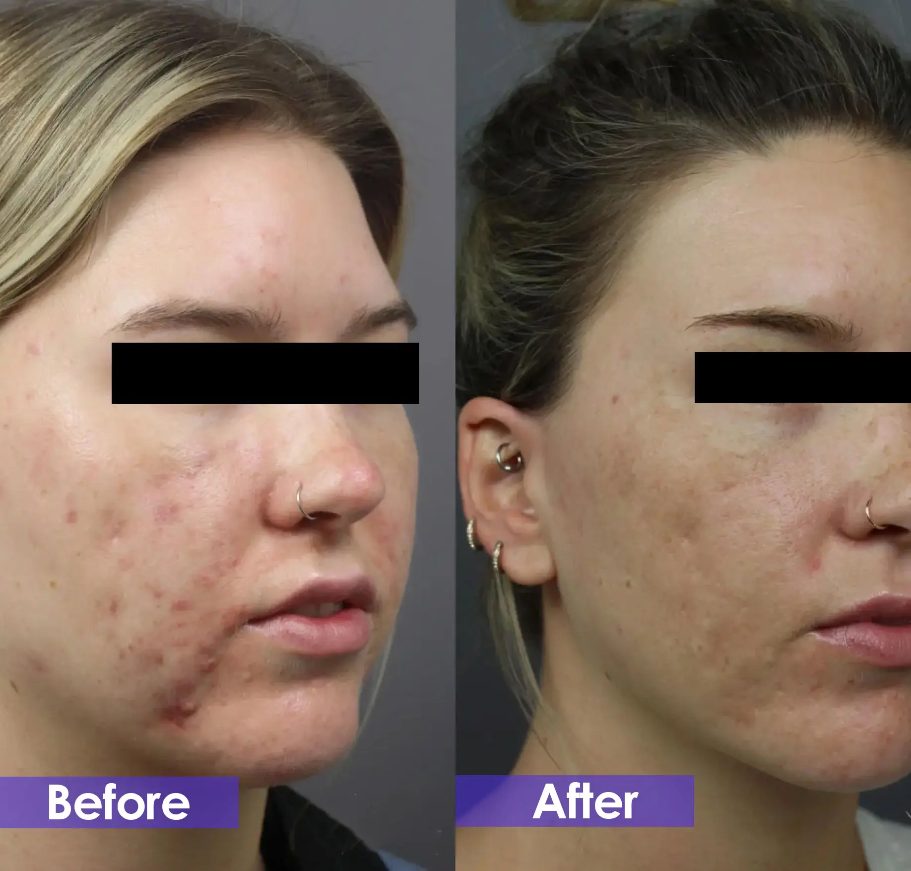 IPL Treatment for acne removal before and after